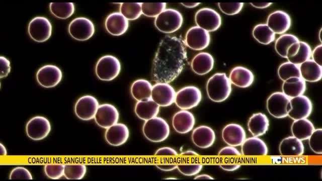 TG NEWS Coaguli di globuli rossi nel sangue dei vaxxinati..