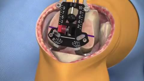 Total knee replacement surgery