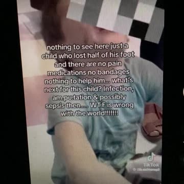 BDS Palestinian kid with no pain killers…