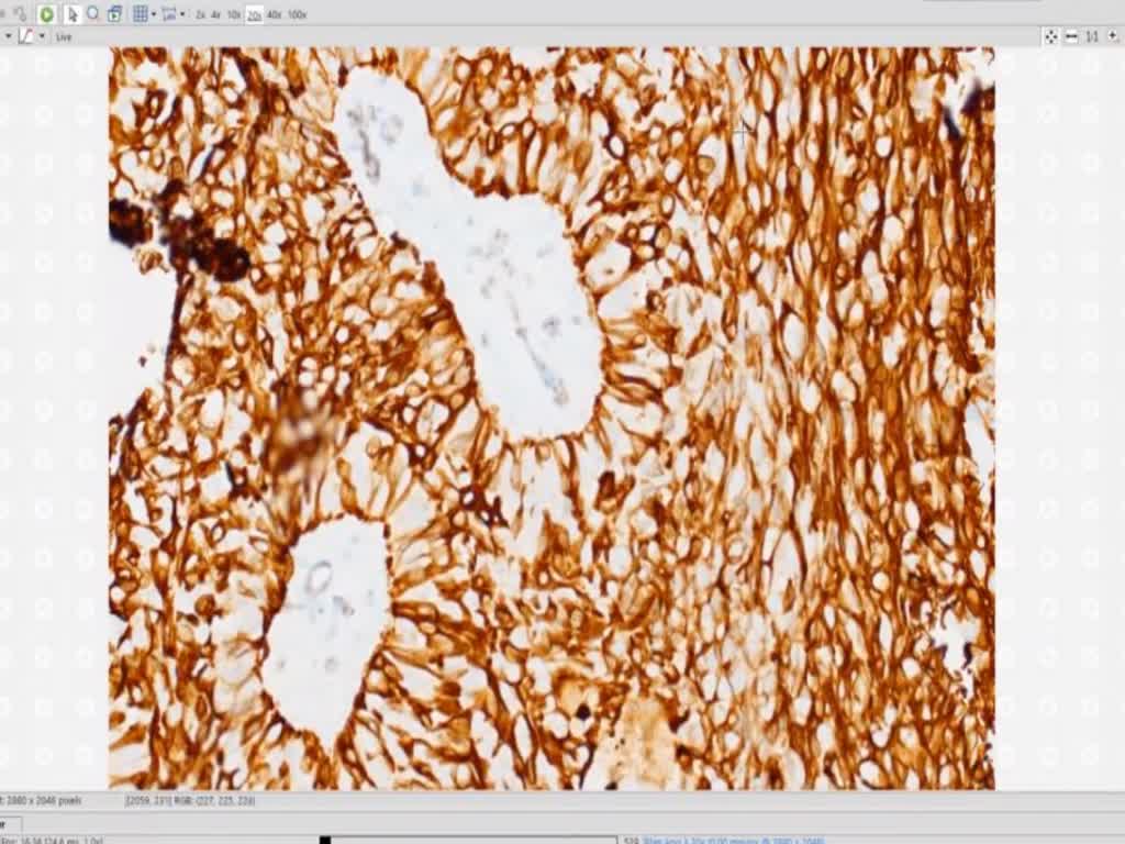 ER and CK5/6 in atypical breast lesions, dr. cimino