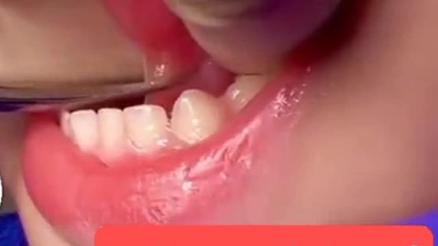 Frenectomy