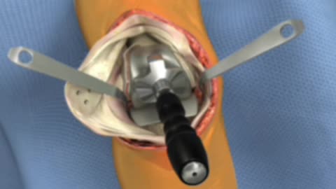 Anthem posterior stabilised with metal trials, Implant Insertion part - 9