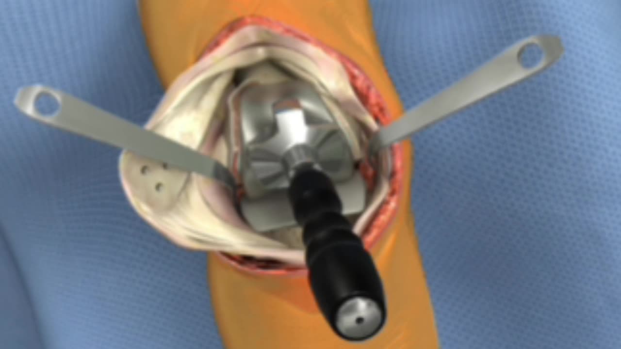 Anthem posterior stabilised with metal trials, Implant Insertion part - 9