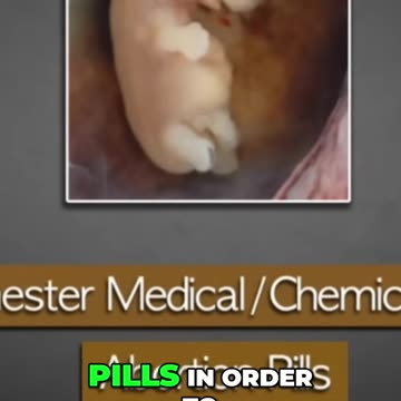 First Trimester Medical Abortion: