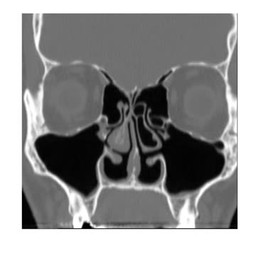 Anxiety and Depression via EMPTY NOSE SYNDROME