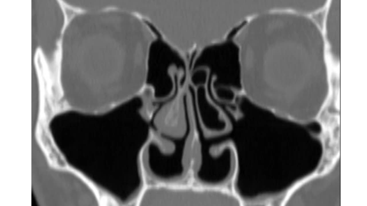 Anxiety and Depression via EMPTY NOSE SYNDROME