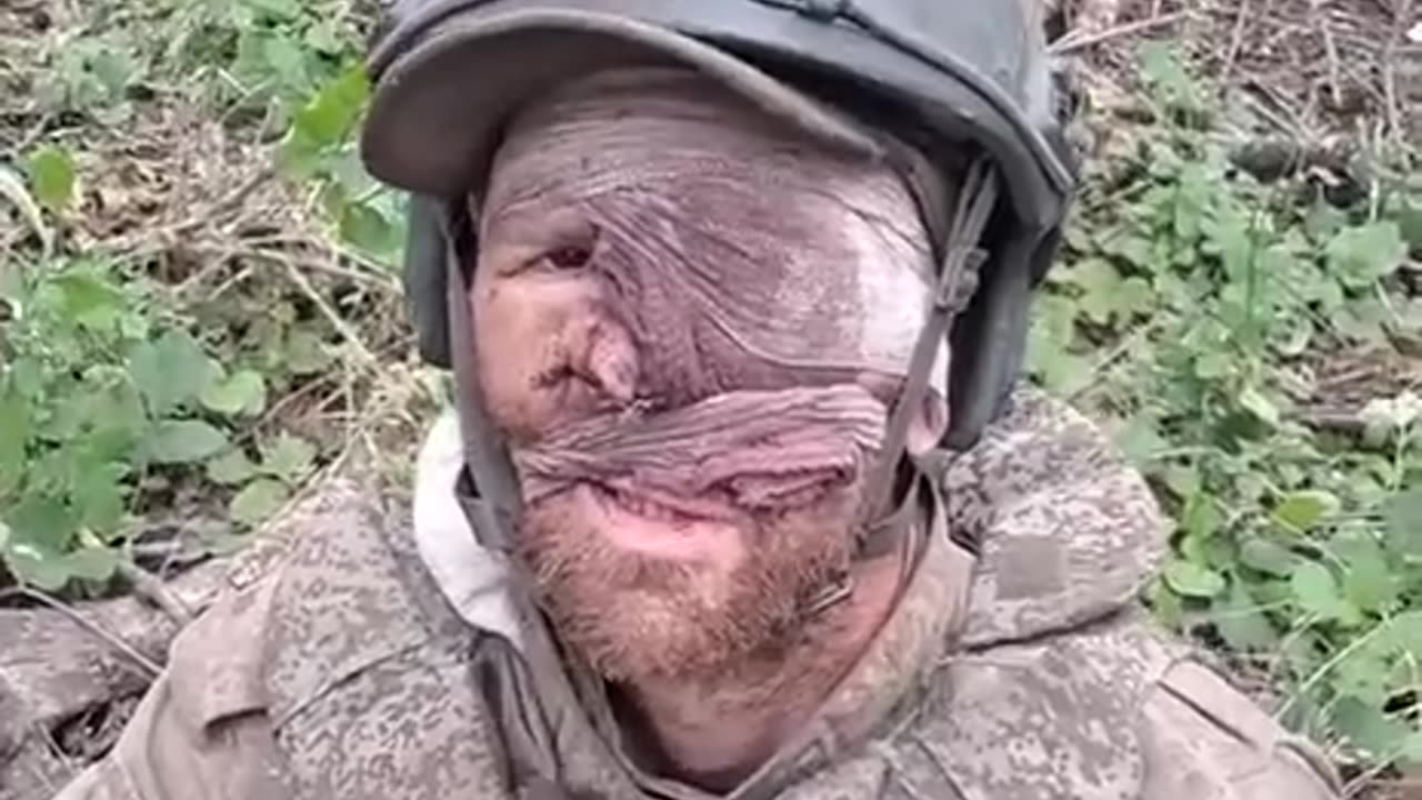 Russian Soldier Surrenders to Ukrainians with Only Half a Face