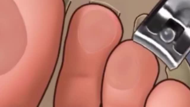 Ingrown ToeNail, Severely Cracked feet ASMR treatment