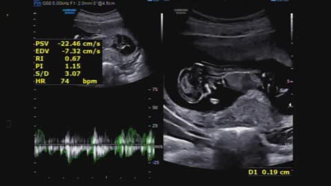 Baby ultrasound image and sound (2)