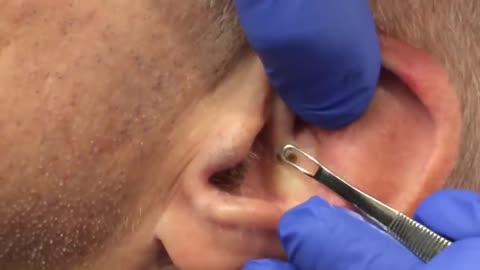 Ear Blackhead Extraction