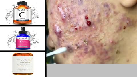 Pimple, satisfaction,complication