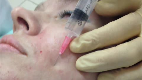 Ozone injection into wrinkles