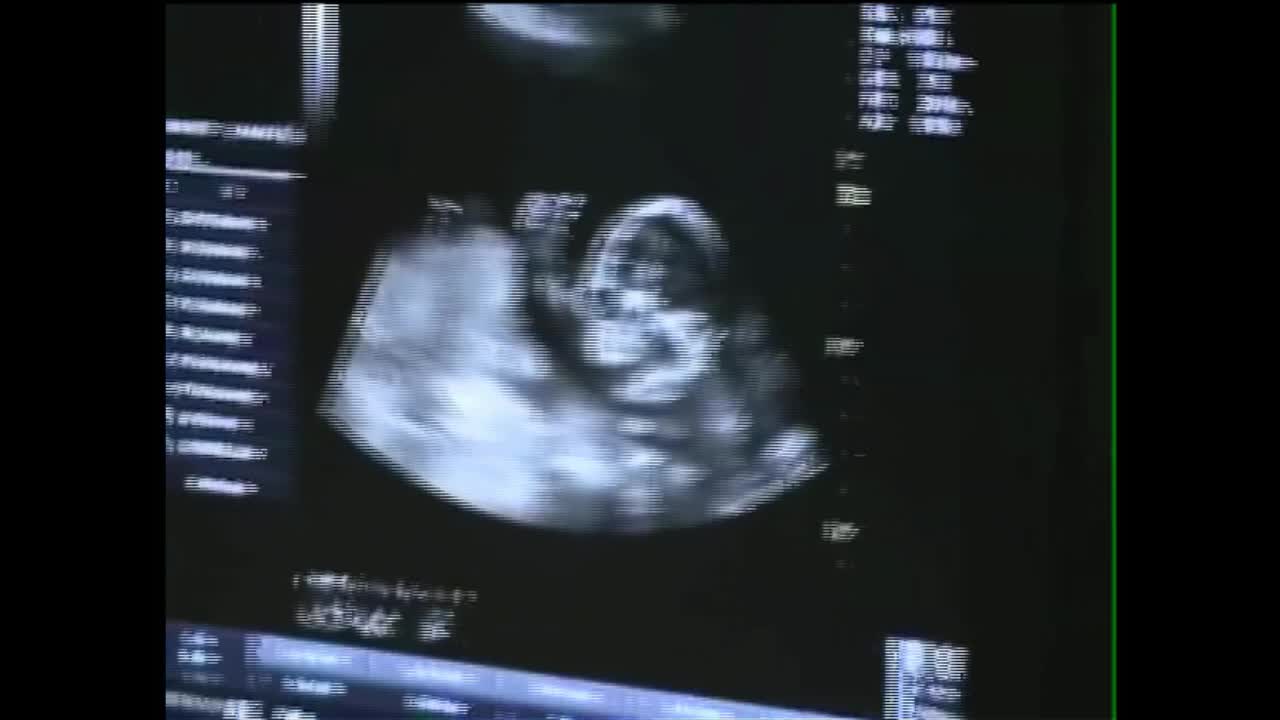 Baby On Ultrasound Gives The Thumbs Up