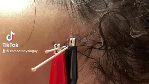 Electro dry needling of the sub occipitals 💪