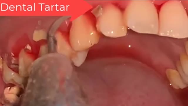 Tartar Dentist 2021 | Satisfying Dental-work