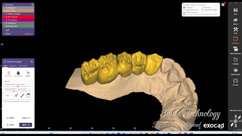 #design #naildesign #dental #dentaldesign #exocadexpert