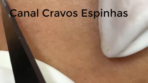 Giant Blackheads and Pimples Squeezing Blackheads #03