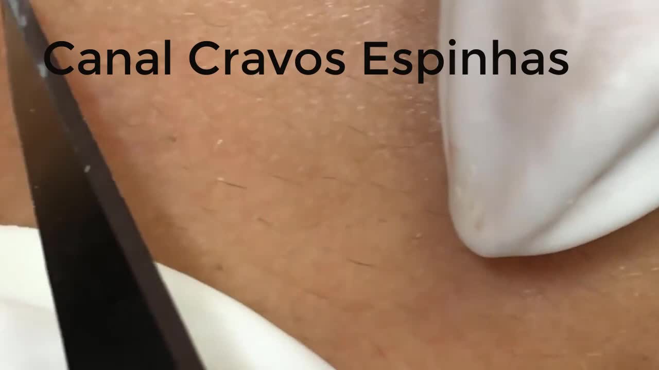 Giant Blackheads and Pimples Squeezing Blackheads #03