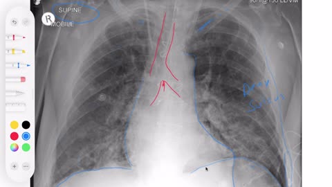 CXR Deep Sulcus sign