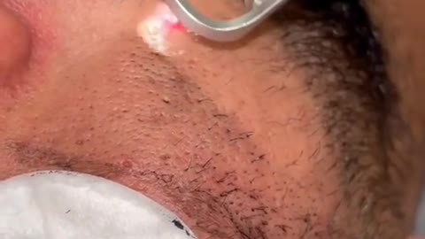 Black head remover with Lazar