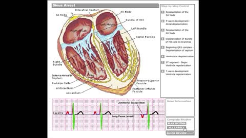 Dr Stanley's ECGcourse.com | Sinus Arrest Tutorial