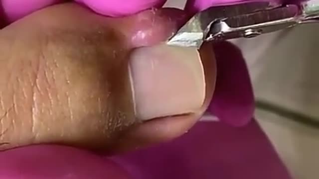 JAMMED NAILS - ALL CARE IS LITTLE