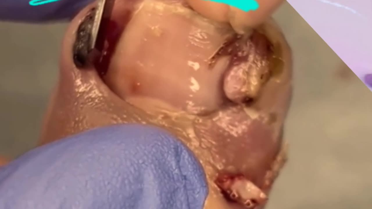 Overgrow toenail
