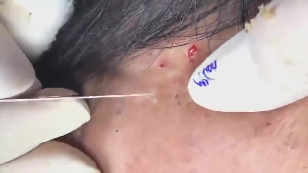 Acne removal and treatment 1