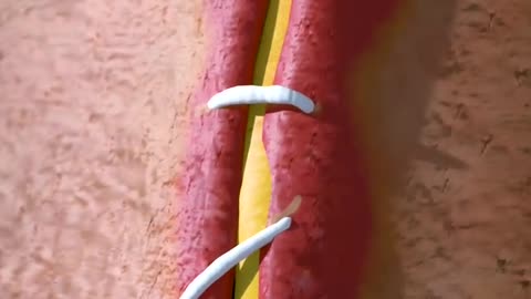 How Stiches Work