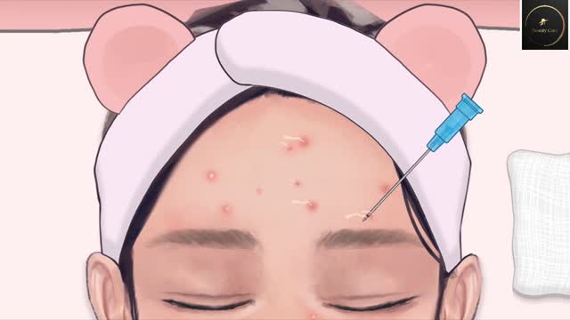 ASMR | Acne Removal Skin Care | Beauty Care