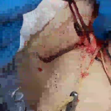 Covid "Vaccines" Clotting- Death Jabs