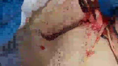 Covid "Vaccines" Clotting- Death Jabs