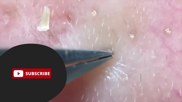 Giants Deep Blackheads, Whiteheads, Big Pimples, Hidden Acne Removal - Best Popping Videos #000038