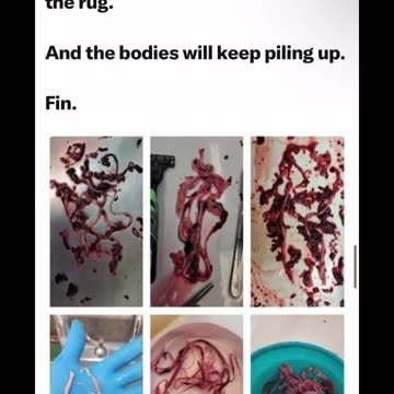 John Campbell: Richard Hirschman: clot from carotid artery after death