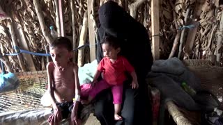 Yemeni boy, ravaged by hunger, weighs 15lb