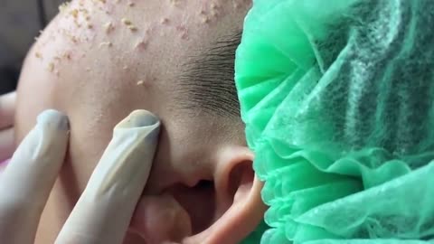 Extremely satisfying blackhead and whitehead removal video