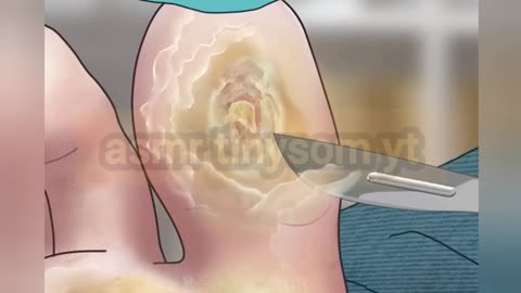 ingrown toenails treatment asmr | 내성발톱 | giantess | callus corn removal from feet |asmr m4m