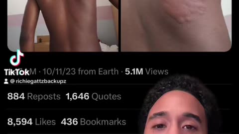 Bro got bedbugs