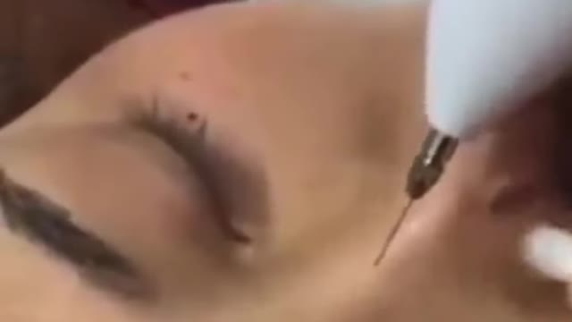 Caneta de plasma - Removedora de manchas e tatuagens na pele