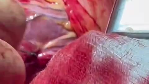 Shrapnel in the heart