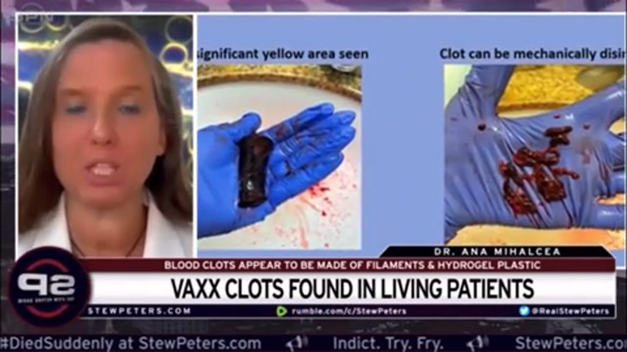 Hydrogel from vaxx found in living patients..