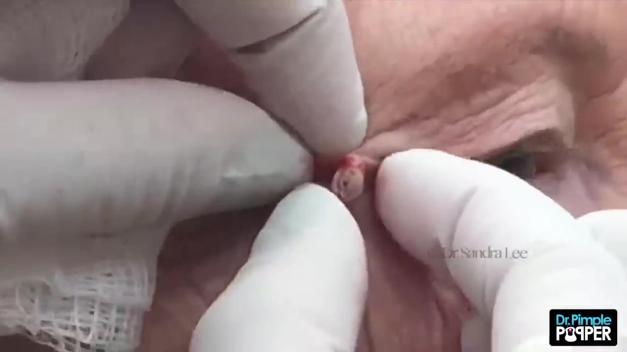 A big blackhead I can't believe I didn't see sooner! (THROWBACK THURSDAY)