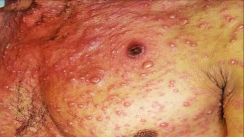 Blackheads, Whiteheads, Psoriasis or Chickenpox?