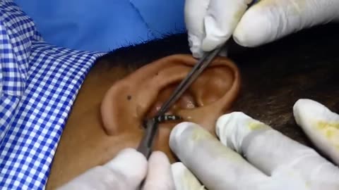 ENT Doctor Try to Remove Insect