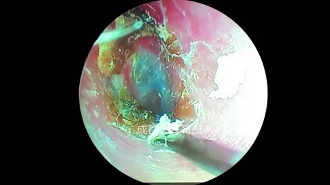 gigantic ear wax removal #40