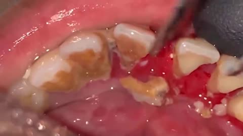 Satisfying Tartar Removal