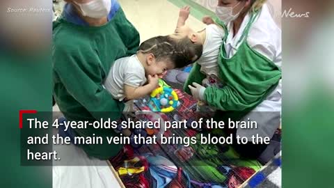 Rare conjoined twins connected at the head separated in Brazil