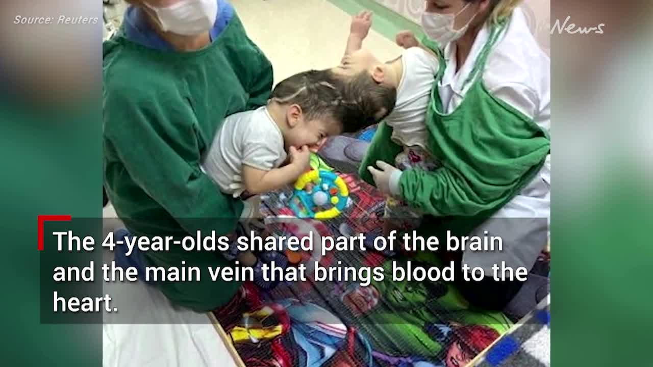 Rare conjoined twins connected at the head separated in Brazil