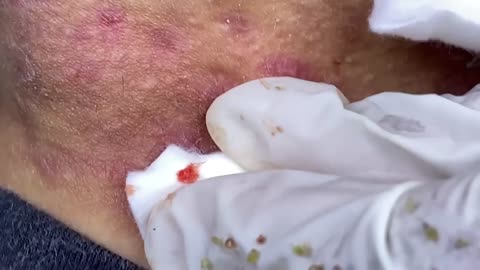 Bad Acne