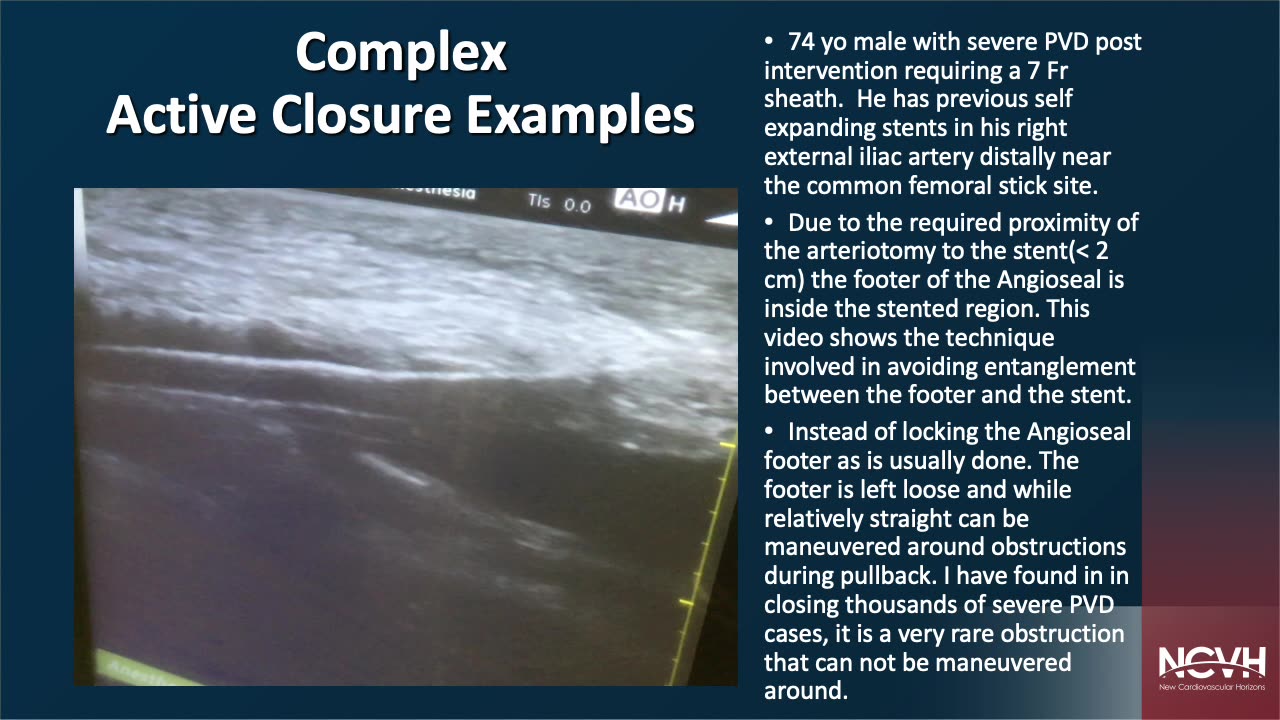 Active closure Basics